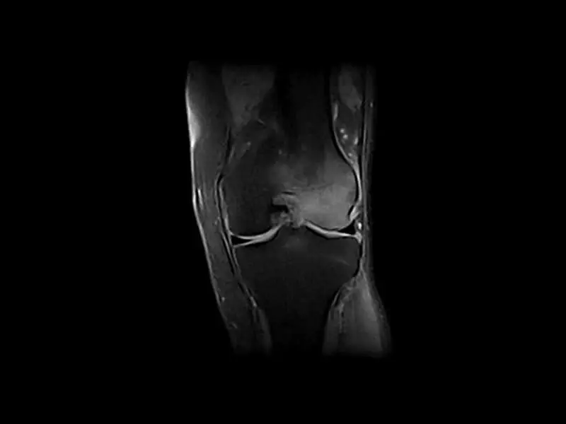 Image clinique G-scan du genou en SPED coronal