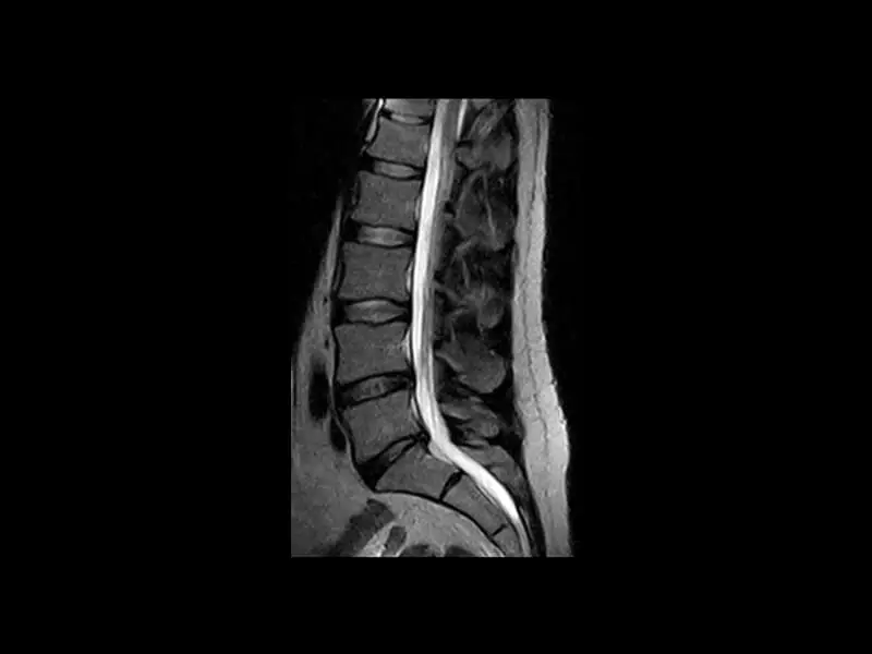 Image clinique G-scan du rachis lombaire en FSE T2 sagittal