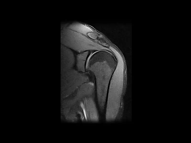 Image clinique G-scan de l'épaule en SPED coronal
