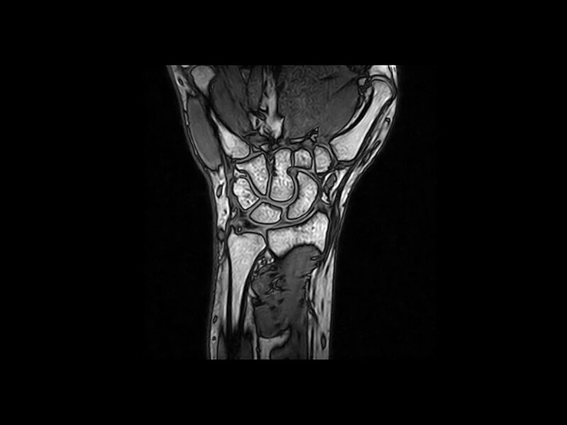 Image clinique G-scan du poignet en 3D SST1 sagittal