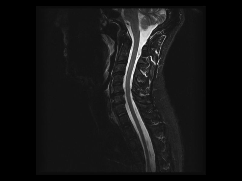 Image clinique Esaote HyperClarity du rachis cervical