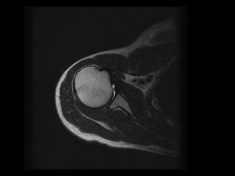 Image clinique Esaote HyperClarity de l'épaule en axial