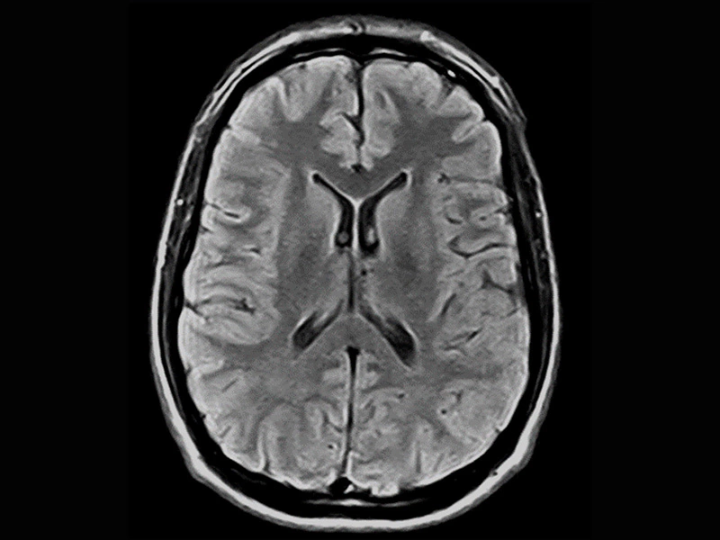 Image clinique Magnifico du cerveau en FLAIR axial