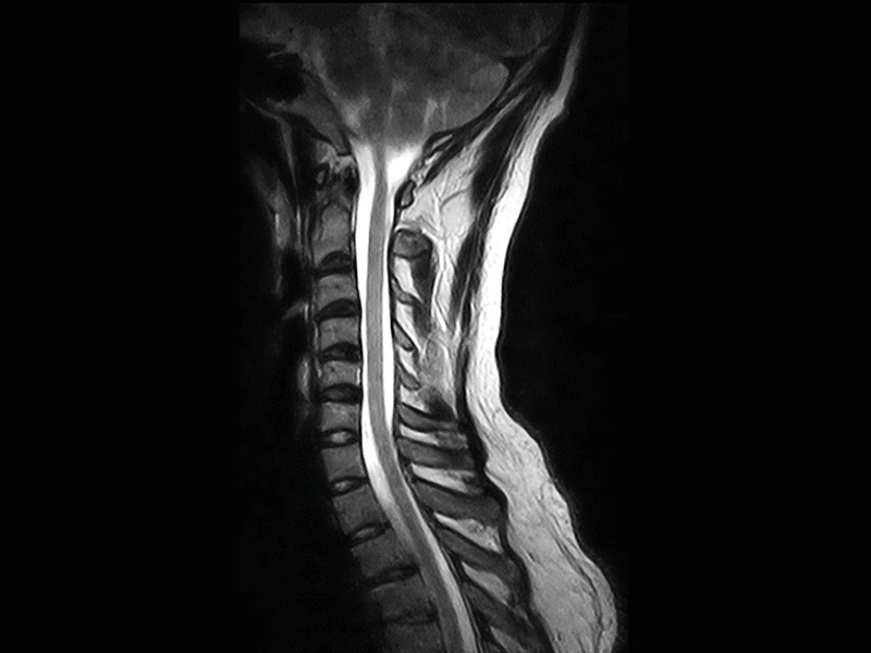 Image clinique Magnifico du rachis cervical en FSE T2 sagittal