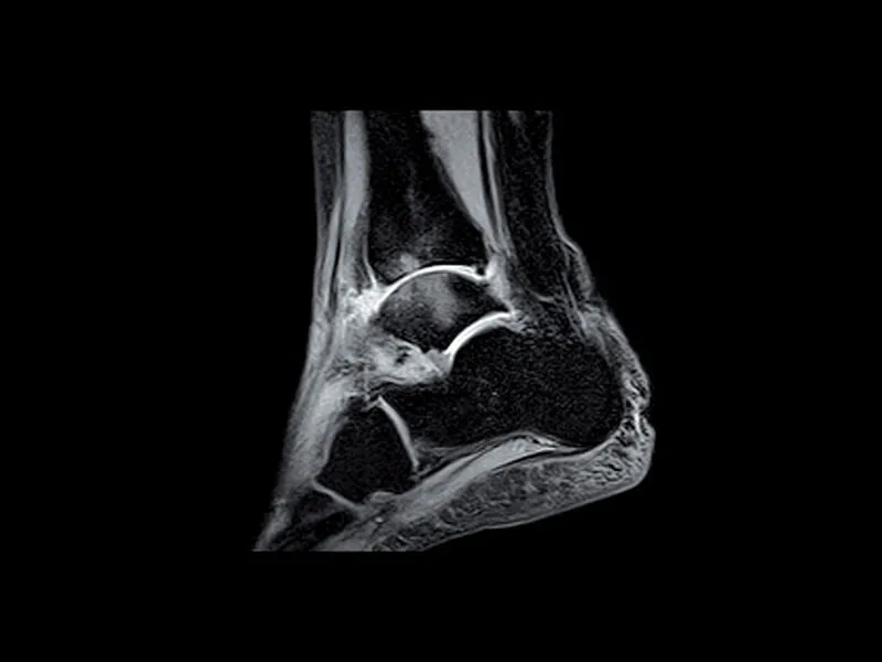 Image clinique O-scan de la cheville en STIR sagittal