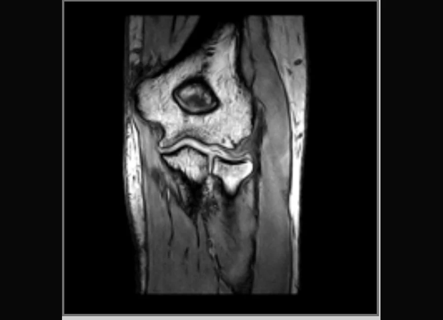 Image clinique O-scan du coude en 3D SHARC coronal