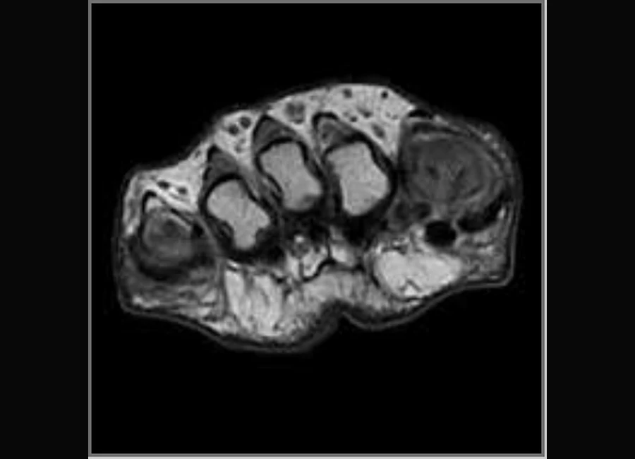 Image clinique O-scan du pied en SpinEcho T1 axial