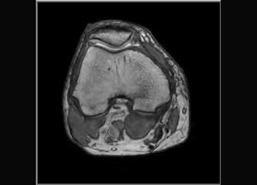 Image clinique O-scan du genou en 3D SHARC axial
