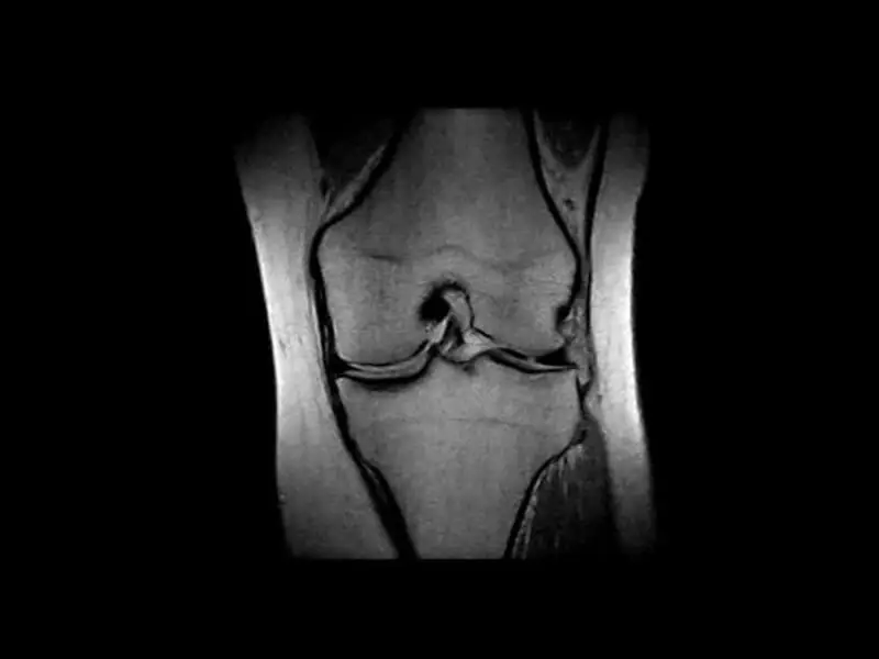 Image clinique O-scan du genou en PD coronal