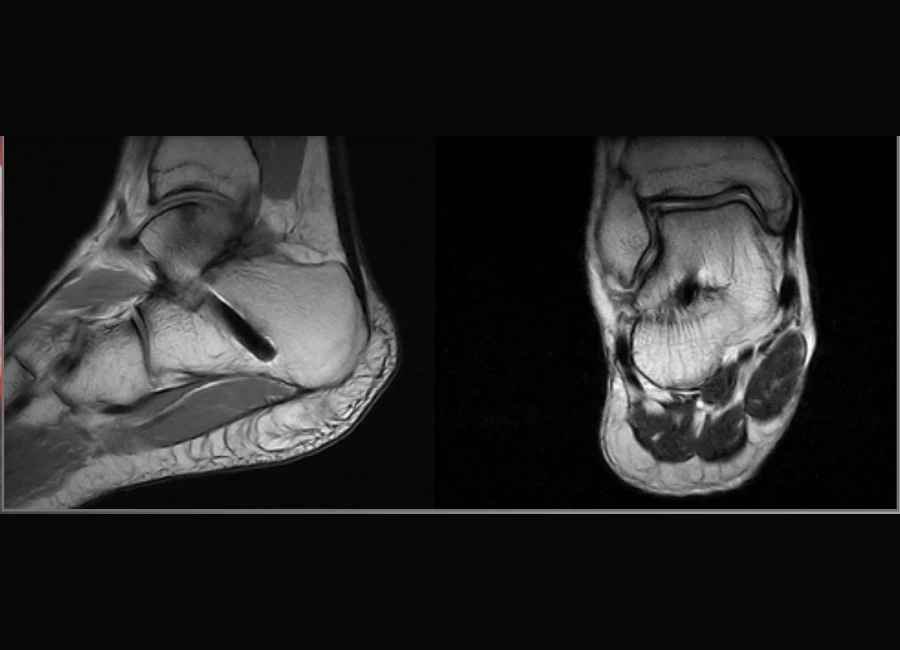 Images cliniques O-scan illustrant la réduction des artéfacts métalliques