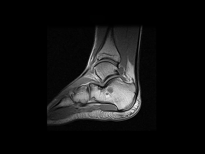 Image clinique S-scan de la cheville en SE T1 sagittal
