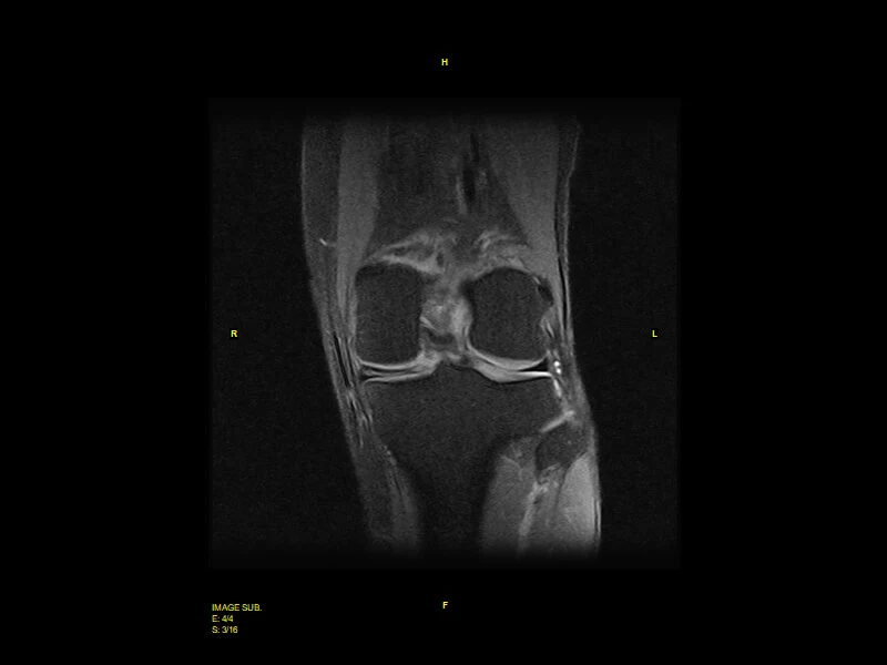 Image clinique S-scan du genou en SPED coronal