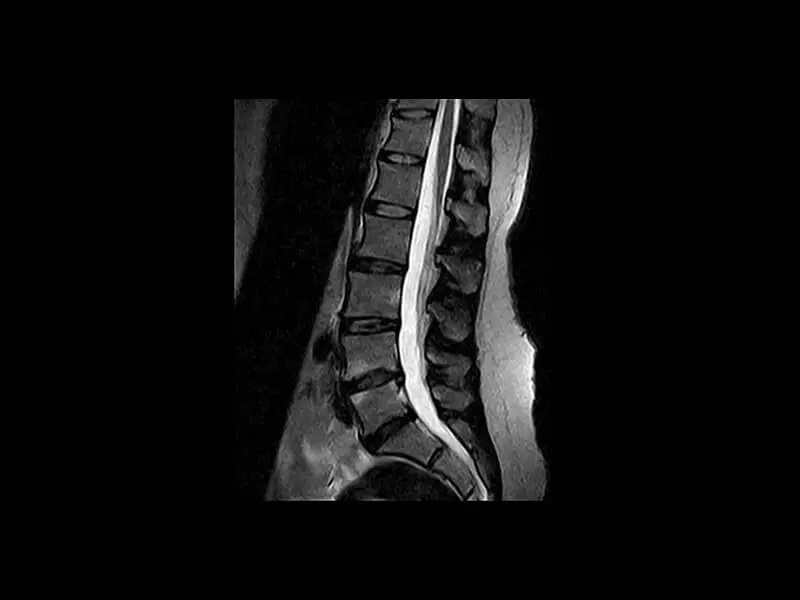 Image clinique S-scan du rachis lombaire en T2 sagittal