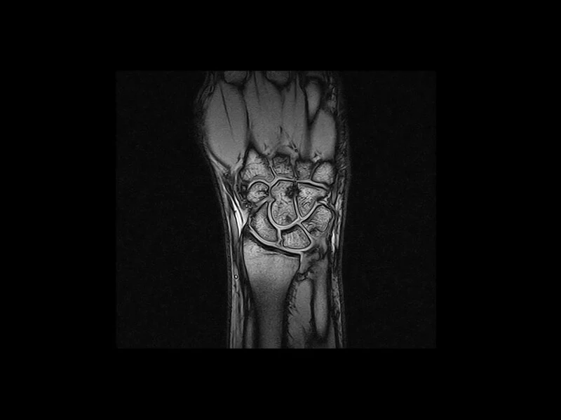 Image clinique S-scan du poignet en GE T1